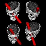 Lesión provocada por un accidente a Phineas Gage
